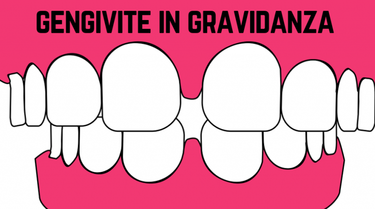 gengivite in gravidanza