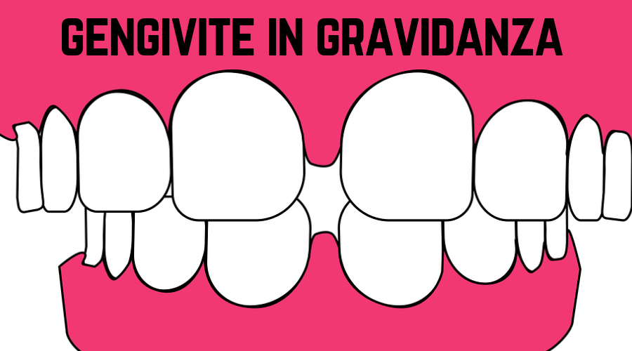 gengivite in gravidanza