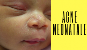 acne neonatale