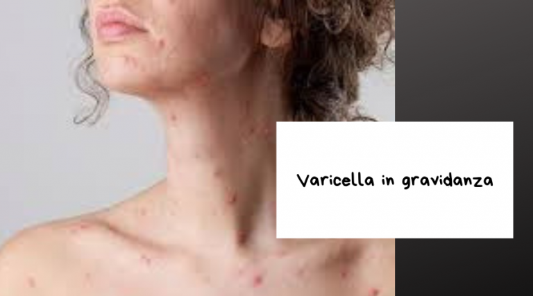 varicella in gravidanza