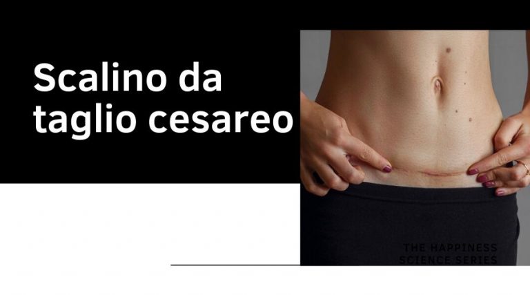 Scalino da taglio cesareo: di cosa si tratta?