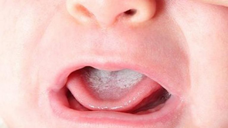 lingua bianca neonato